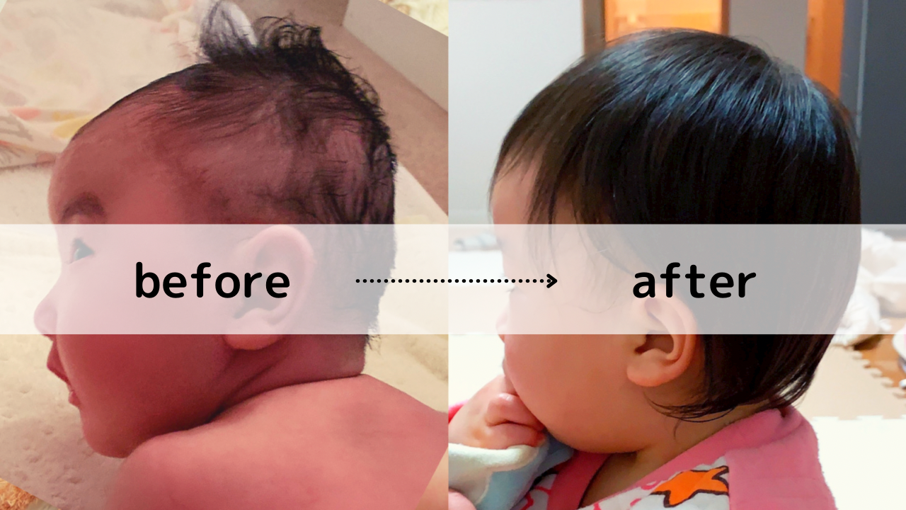 赤ちゃん絶壁は自然になおる 生後3ヶ月 1歳まで経過写真あり La Sana